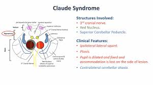 Claude Syndrome的位置